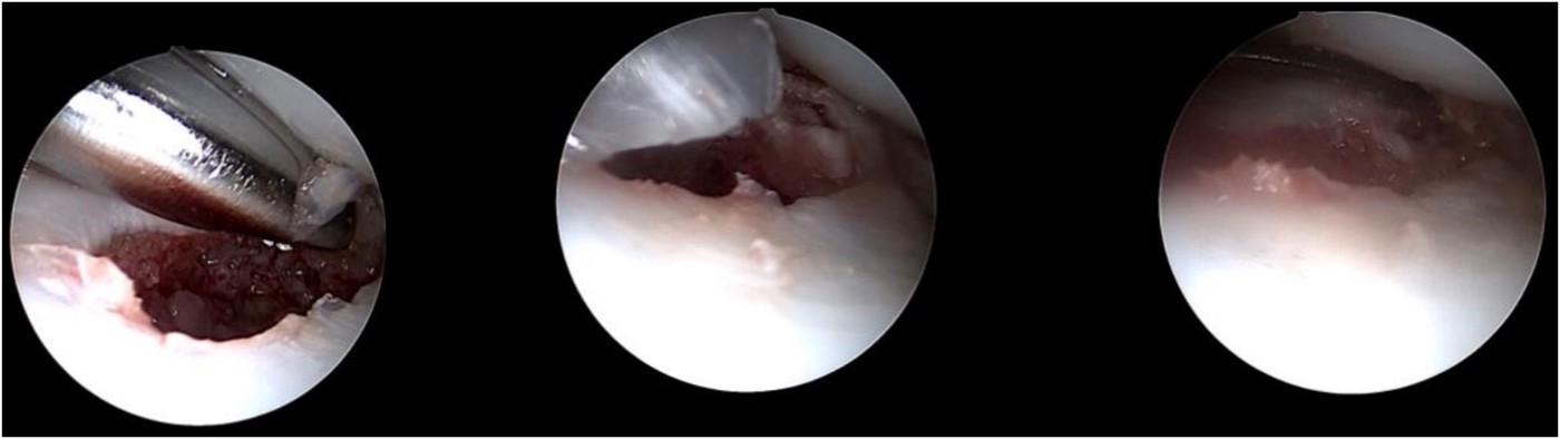 Vues arthroscopiques du traitement de la pseudarthrose du scaphoïde