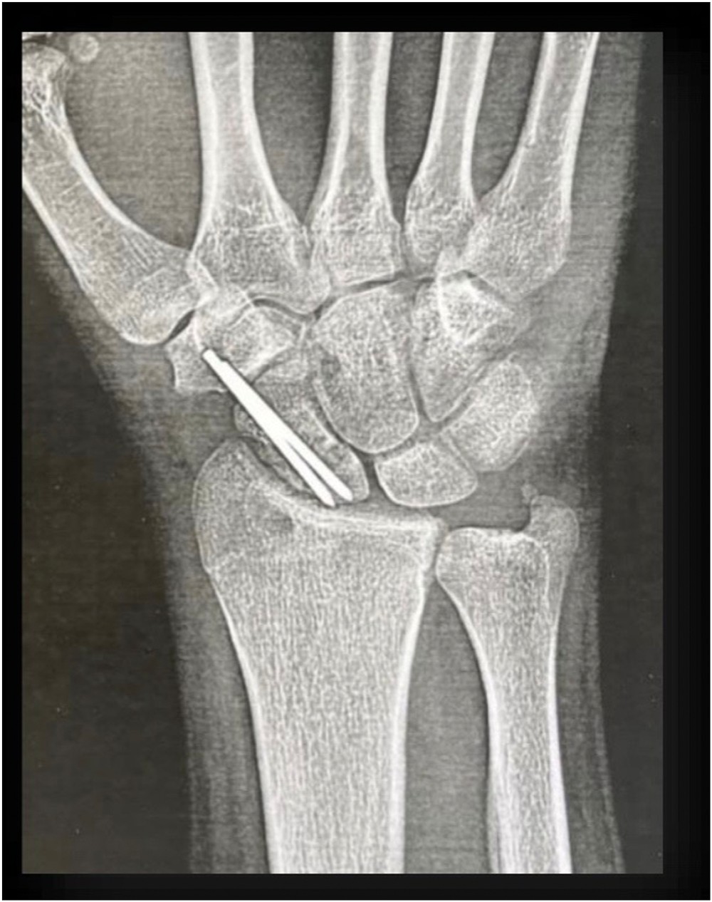 Radiographie de contrôle après greffe osseuse et fixation par broches d'une pseudarthrose du scaphoïde